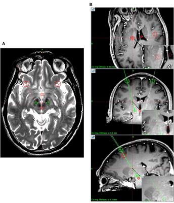 A Modified Dura Puncture Procedure to Reduce Brain Shift in Deep Brain Stimulation Surgery: One Institution's Experience